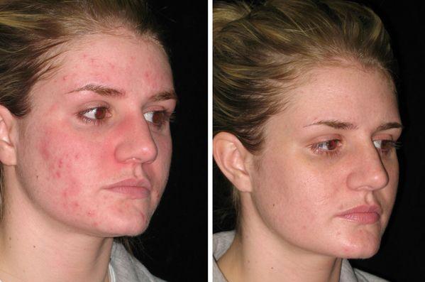 Doxycycline Acne