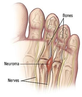 Foot Pad Pain