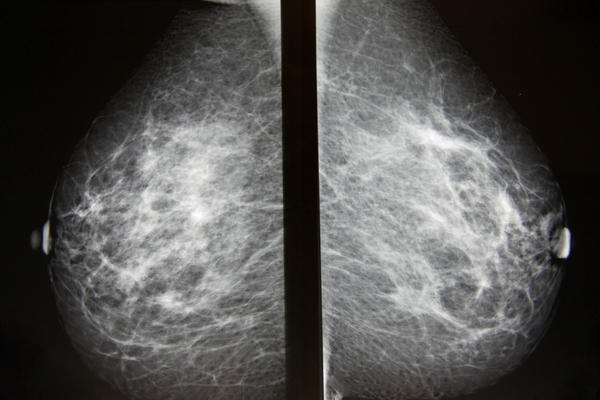 Benign Mammogram