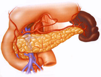 metastatic pancreatic cancer