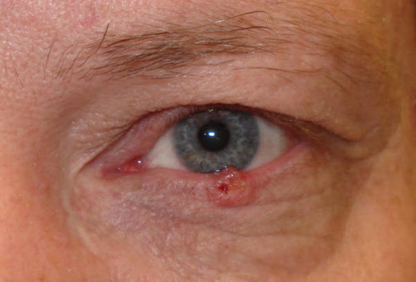 Eye Cancer Symptoms
