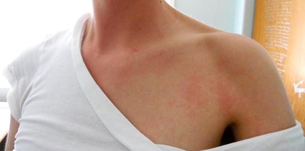 Most Bizarre Allergies