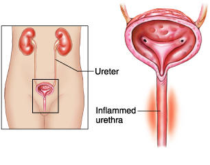 What Is Urethritis