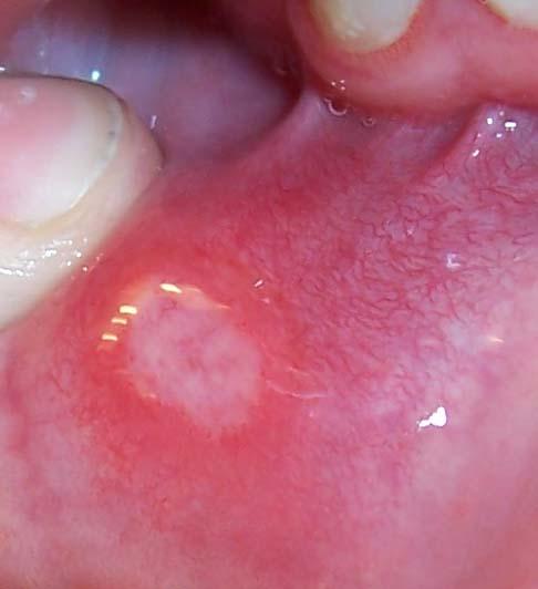 herpes lesions images