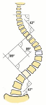 Scoliosis Muscle Imbalance