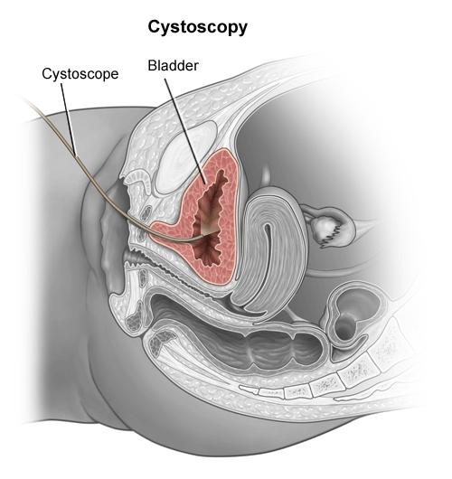 burning during urination