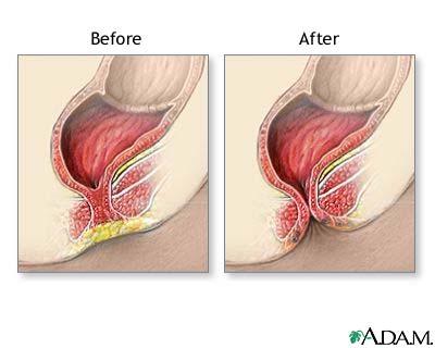 Imperforate Anus Surgery