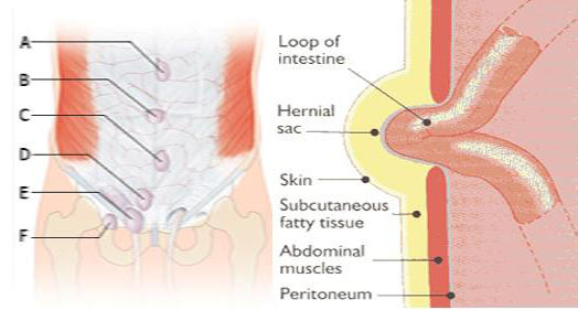 Abdominal Hernia Symptoms