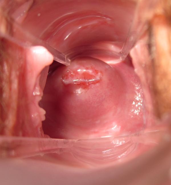 Watery Discharge 5 Days After Ovulation