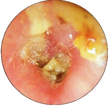 Ear Wax