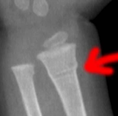 Ulna Break