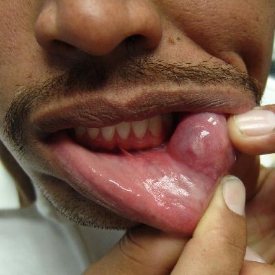 Tongue Cyst