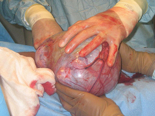 Follicular Cyst