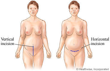 Oxycodone and Acetaminophen Tablets,.