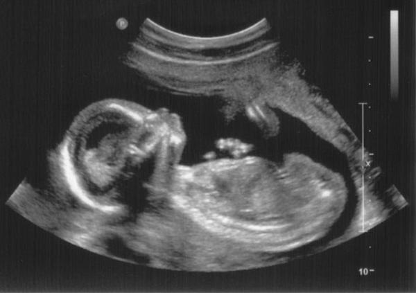 First Trimester of Pregnancy Forum.