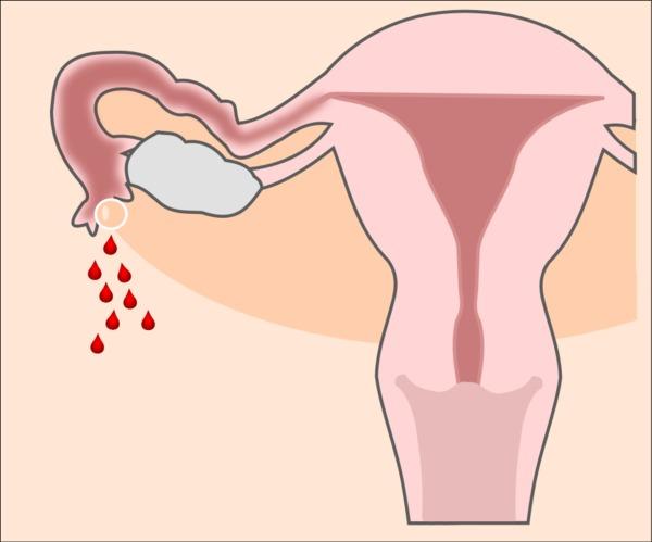 Abortion 1 Month