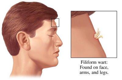Warts On Neck