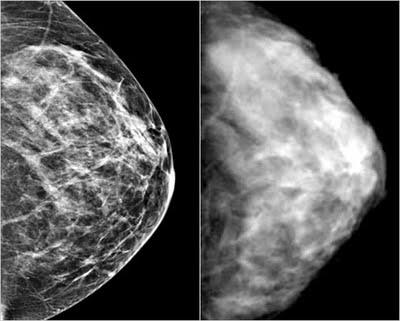 abnormal mammogram photos