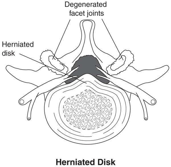 Can I Do Sit Ups With A Herniated Disc