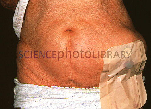 stoma hernia