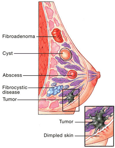 Tubular Adenoma Breast