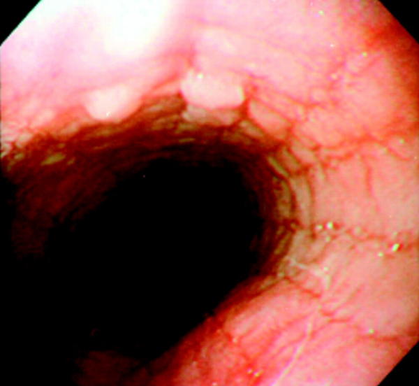 Hpv Lip Warts