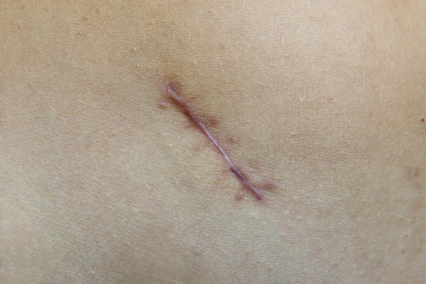 Tanning Scars