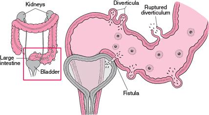 Colon-Bladder-Fistula-Surgery Bladder Diverticula Related Keywords & Suggestions - Bladder ...
