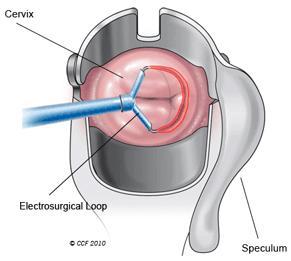 Uterine Biopsy Infection Symptoms