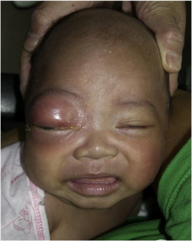 eye discharge yellow