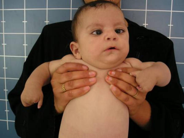 Birth Defects Babies