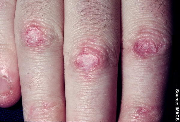 Tanning Scars