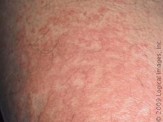 how to treat skin rash from bactrim