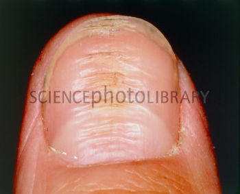 What Does Ripples In Fingernails Mean