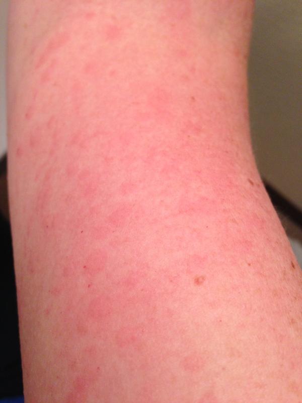 rash with pneumonia