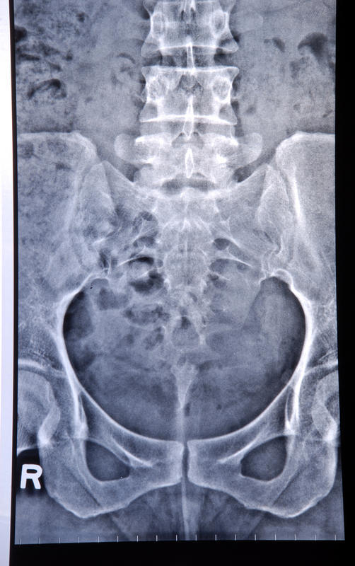 Odorous Mucus In Stool
