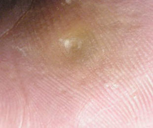 Plantar Warts Published In General On 21st September 2012