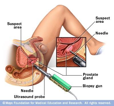 Post Prostate Biopsy Infection Symptoms