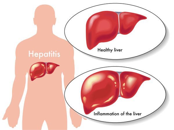 High Ldh Liver Test