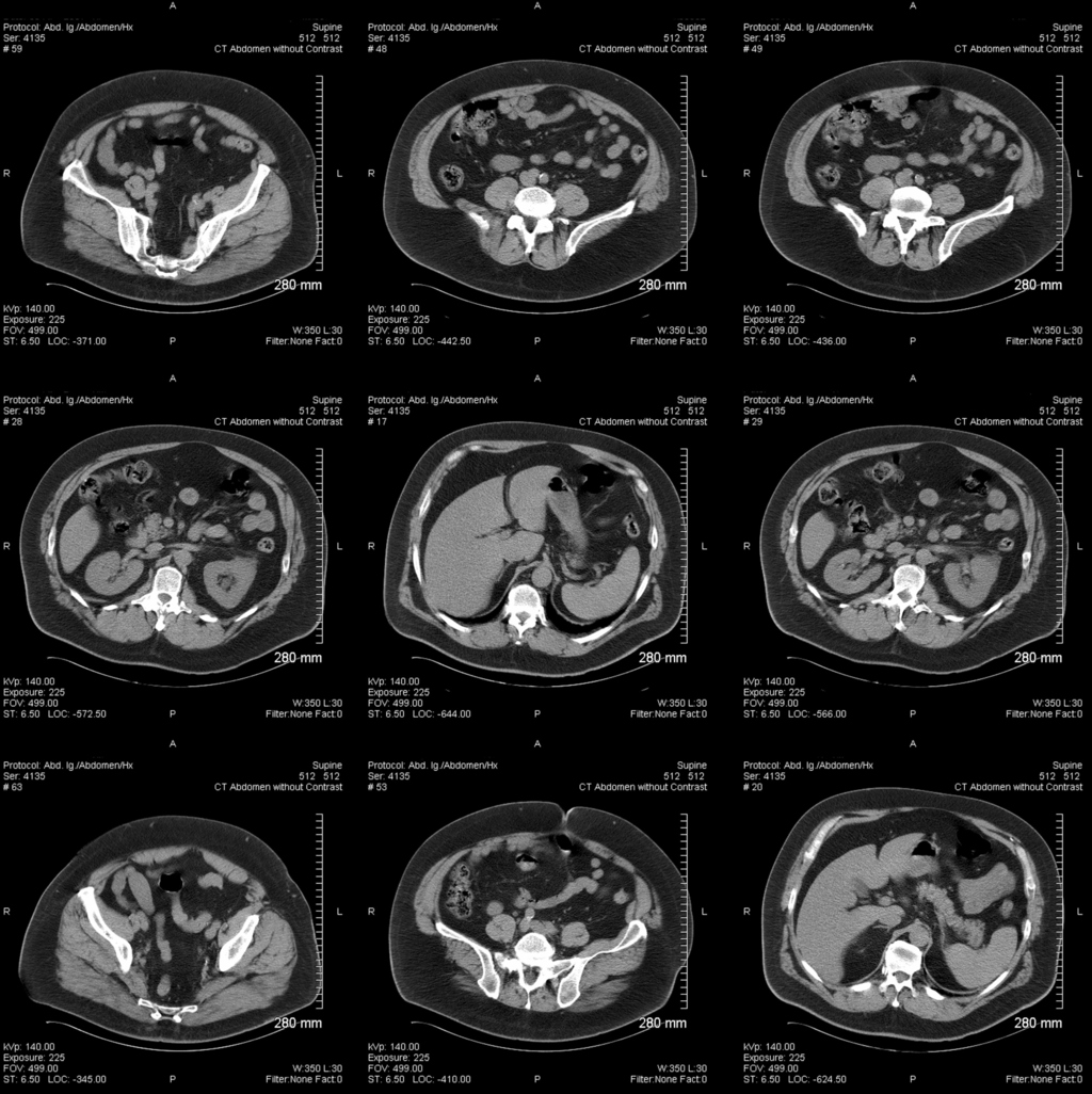 ct scan of abdomen and pelvis without contrast essay Radiol bras vol45 no6 são paulo oct/dec the present study was aimed at describing key computed tomography and magnetic resonance pelvic inflammatory disease is one of the leading causes of abdominal pain in women of but with presence of thickening and contrast-enhancement of tubal walls in association. ct scan of abdomen and pelvis without contrast essay Radiol bras vol45 no6 são paulo oct/dec the present study was aimed at describing key computed tomography and magnetic resonance pelvic inflammatory disease is one of the leading causes of abdominal pain in women of but with presence of thickening and contrast-enhancement of tubal walls in association.