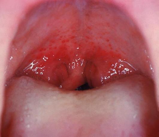 Gonorrhea Throat Symptoms