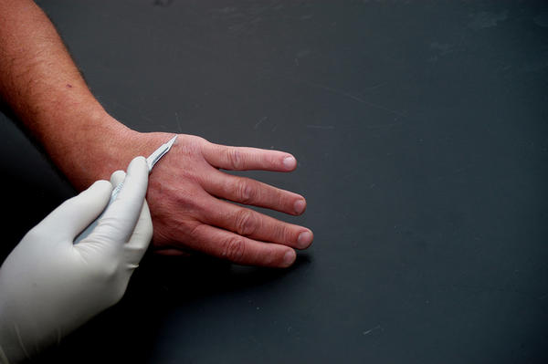 Verruca Finger