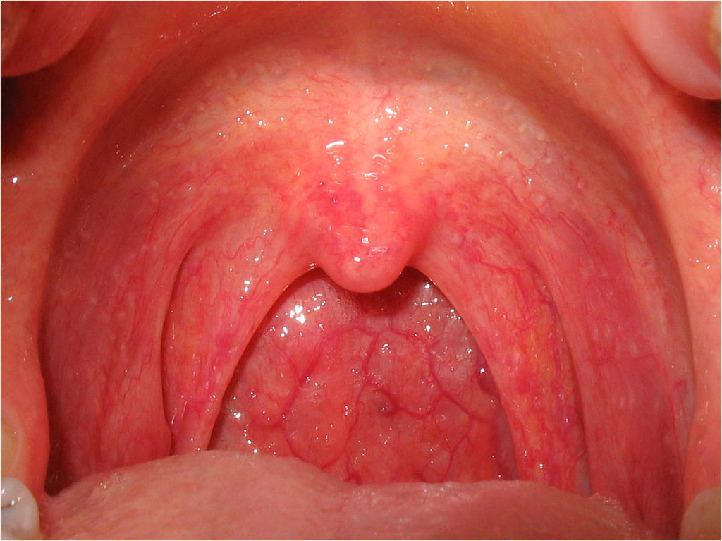 Strep Throat B 71