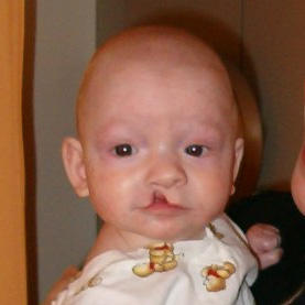Lip Surgery