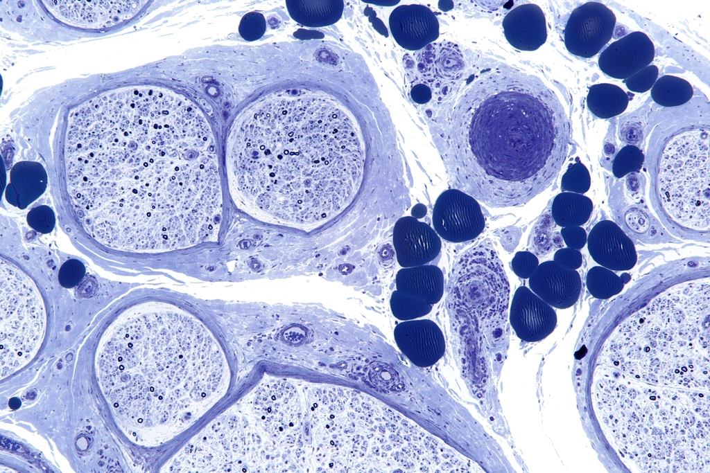 Neuritis Vertigo Vestibular