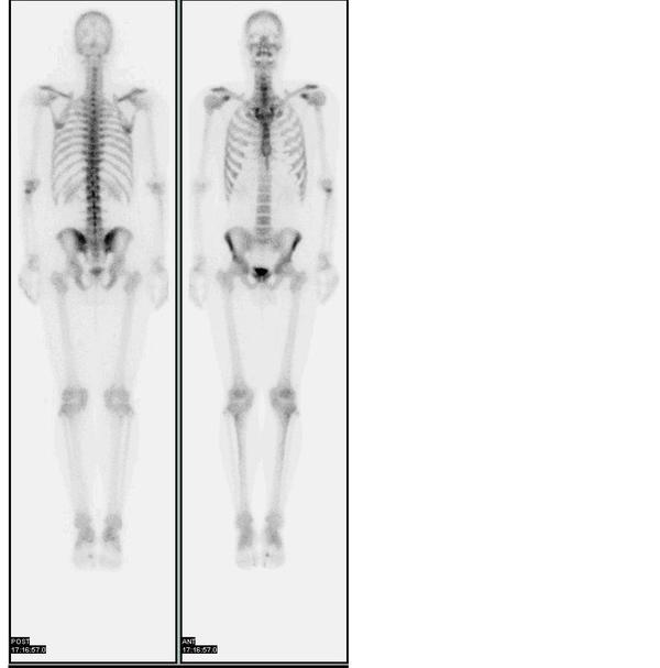 metastatic bone cancer