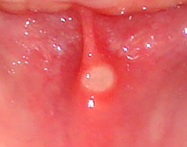 Beginning Mouth Herpes