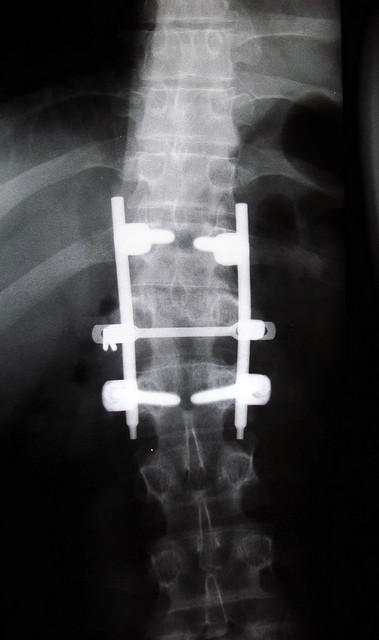 Lumbar Spinal Fusion Recovery Timeline