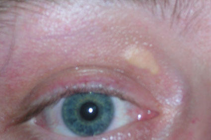 nausea high fever weakness aches