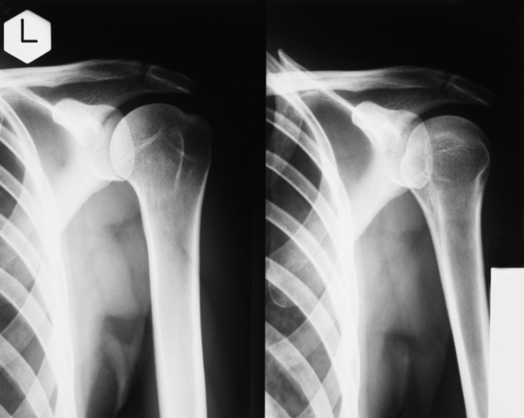 Rotator cuff repair - Answers on HealthTap